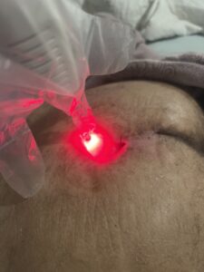 Aplicação Clínica de Laserterapia de Baixa Intensidade